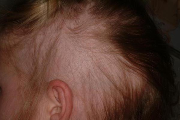 Alopecia in children