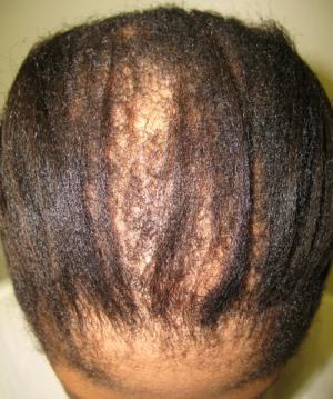 Alopecia in children causes