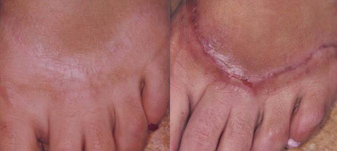 laser resurfacing of scars