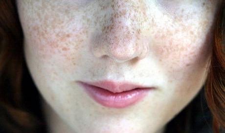 pigment spots on the face, how to get rid