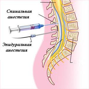 spinal anesthesia is