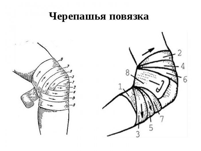 Tortoise bandage on the elbow joint, on the knee joint: superposition