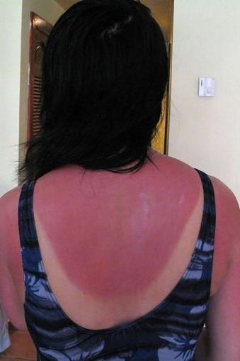 what to do if sun burned