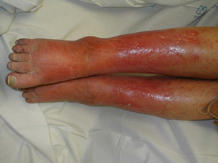 ischemia of the lower limbs