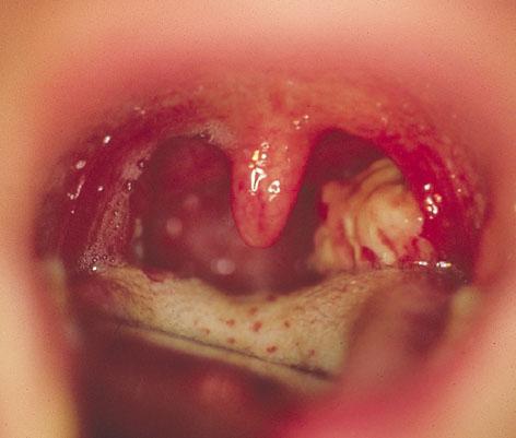 What is tonsillitis?