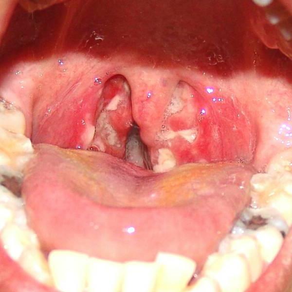 tonsillitis symptoms