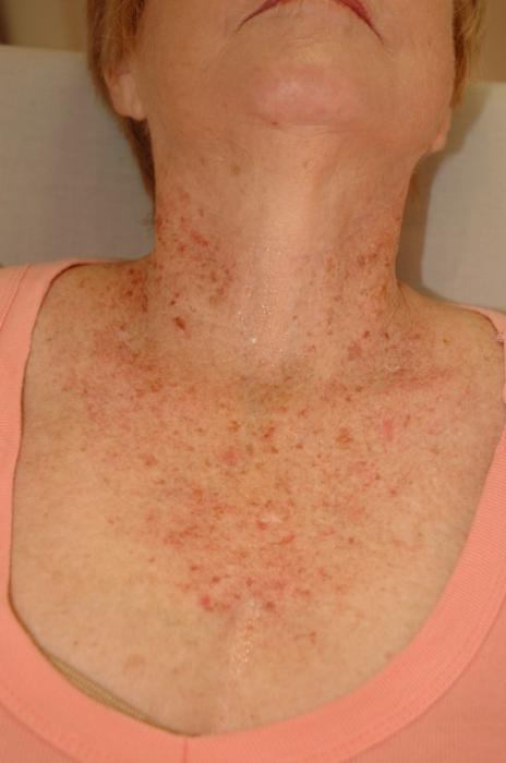 Dermatitis. Treatment, prevention, symptoms.