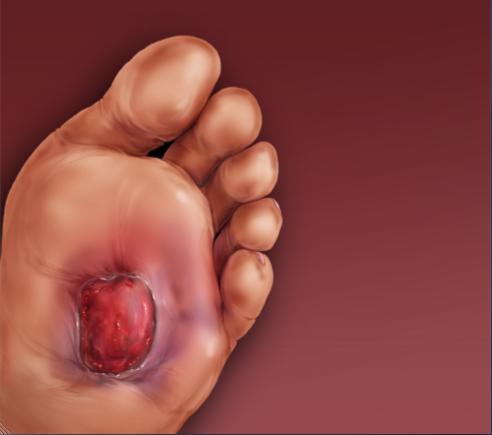 Diabetic Foot: Symptoms and Classification