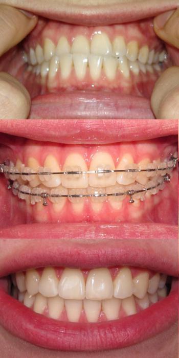 What are the braces needed for?