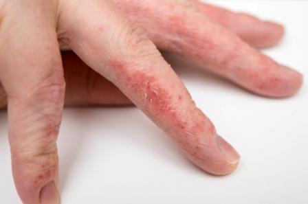 eczema on the fingers