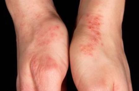 dry eczema on the hands of the cause