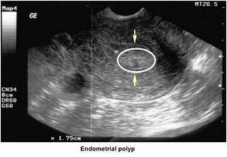 cervical canal