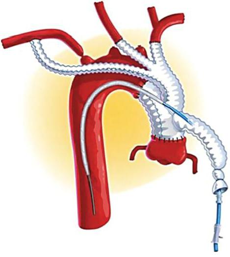 endovascular surgery of the vertebral artery 