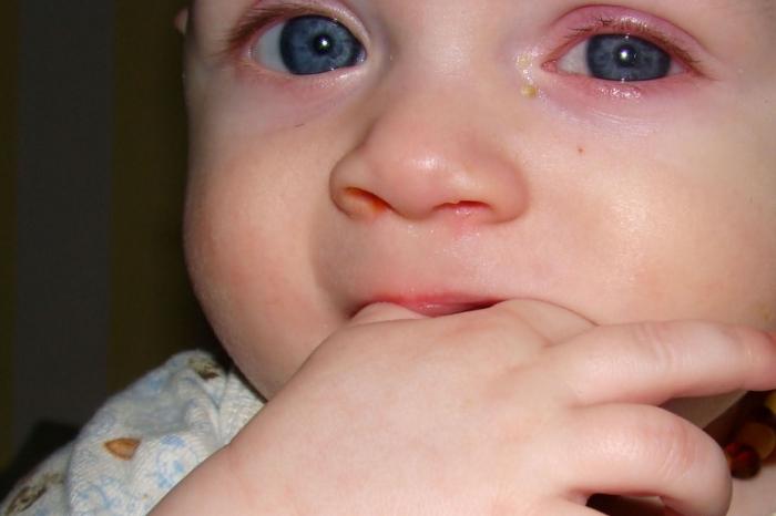 If conjunctivitis is found in a child, than treating the disease