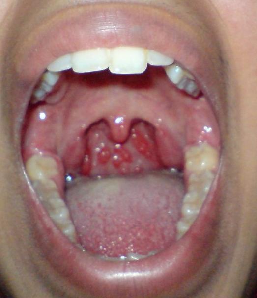 chronic pharyngitis