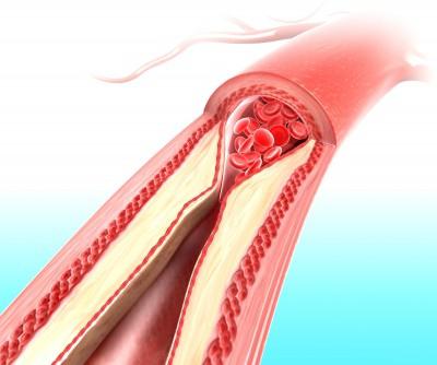 Cardiac ischemia. What is it and what are its manifestations?