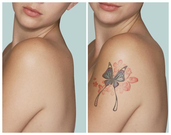 removal of tattoos by a laser in Moscow