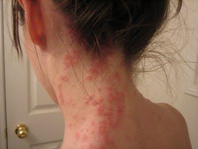 herpetiform dermatitis 