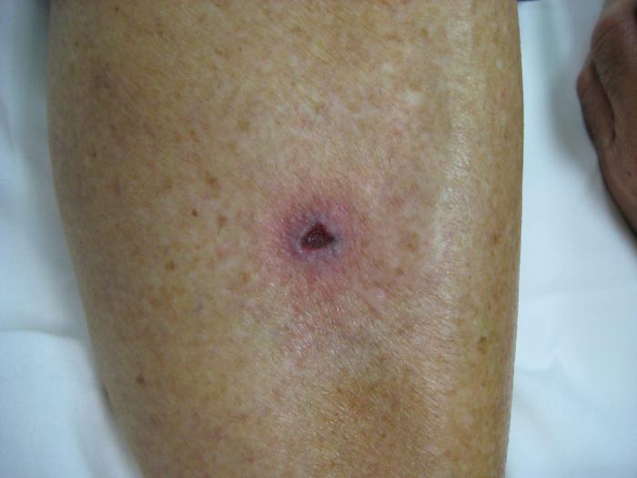 Treatment of trophic ulcers on the leg