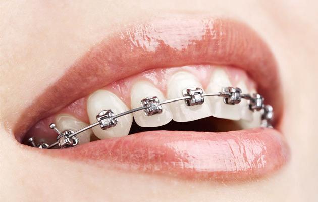 How to put braces in modern dentistry