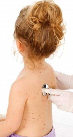 How the child develops chicken pox. Symptoms and Treatment