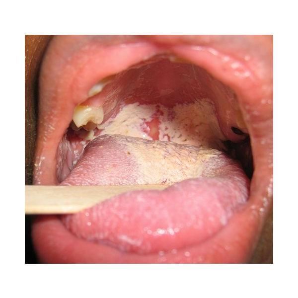 candidiasis stomatitis