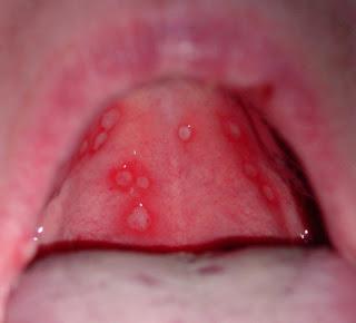 Catarrhal glossitis: how to treat stomatitis in children