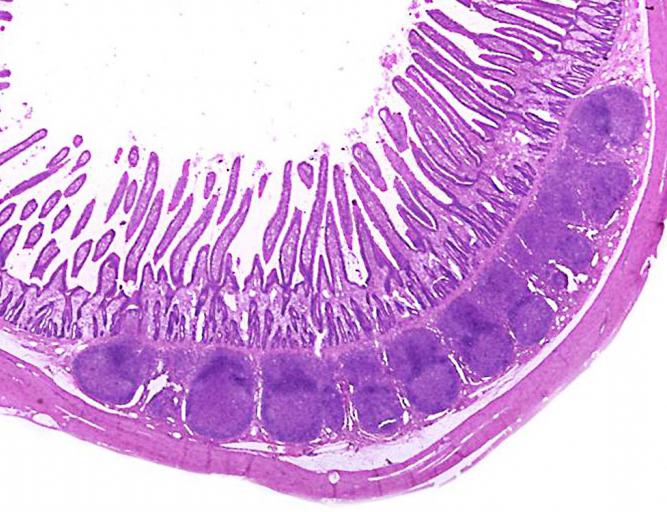 terminal ileum 