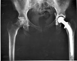 hip replacement