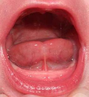 short frenum of the tongue in children