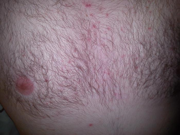 Red spots on the chest: causes and treatment