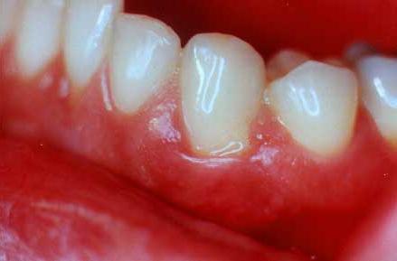 Bleeding gum: what to treat and what are the causes of the disease?