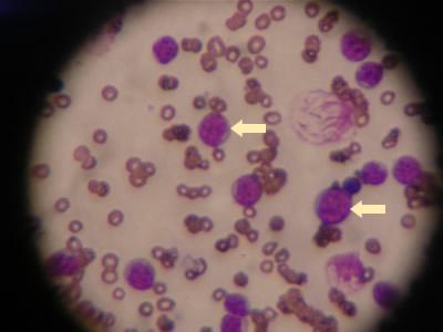 Is leukemia terrible? Symptoms and causes of the disease