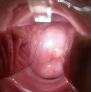 cervical cysts 