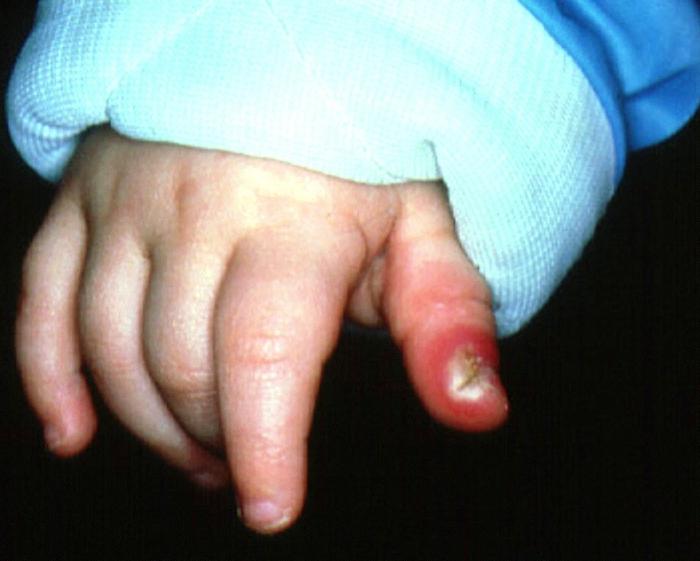 Dumps finger on hand: causes, symptoms and treatment method