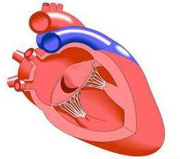 mitral valve seal