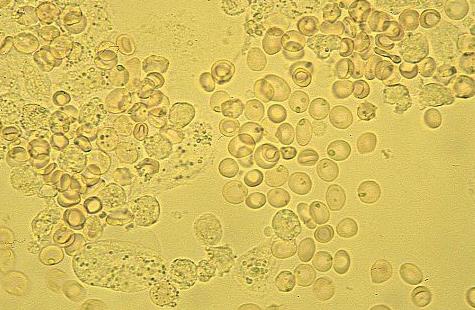 What is evidenced by erythrocytes in the urine of children