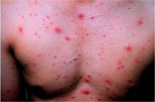 What are the bubbles on the skin? Description and treatment of the most common diseases