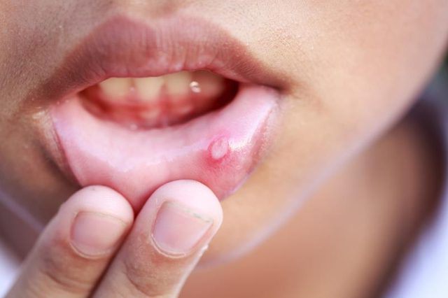 Have they found a callus on the lip of a newborn? Do not panic!