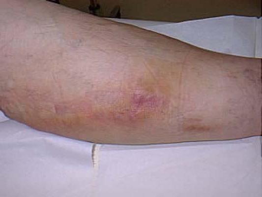 acute thrombophlebitis