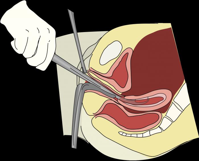 Выскабливание цервикального канала и полости