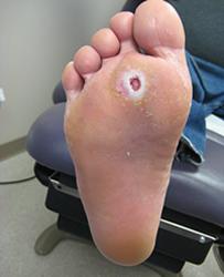 trophic ulcers on legs photo