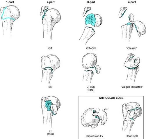 fracture of large tubercle of humerus