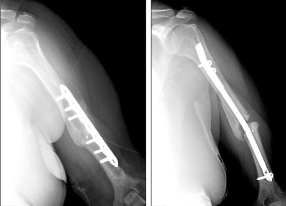 fracture of humerus with displacement