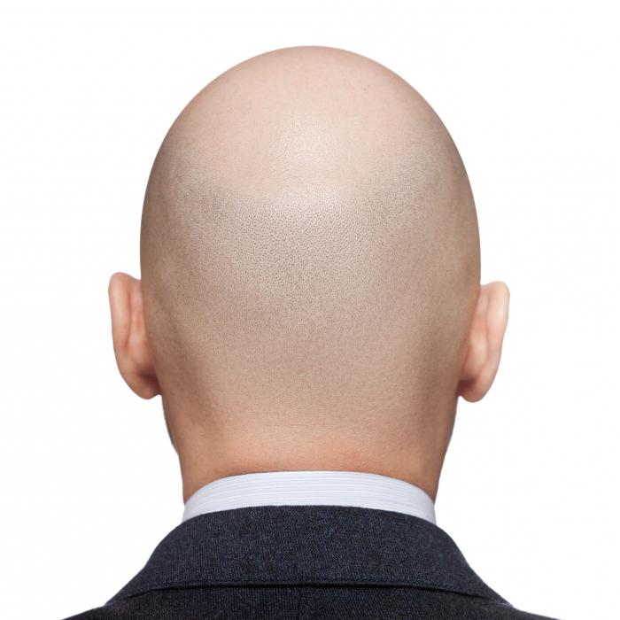 why does a man grow bald 