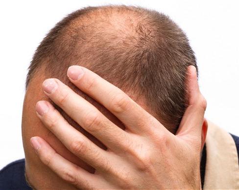 anti-alopecia remedy 