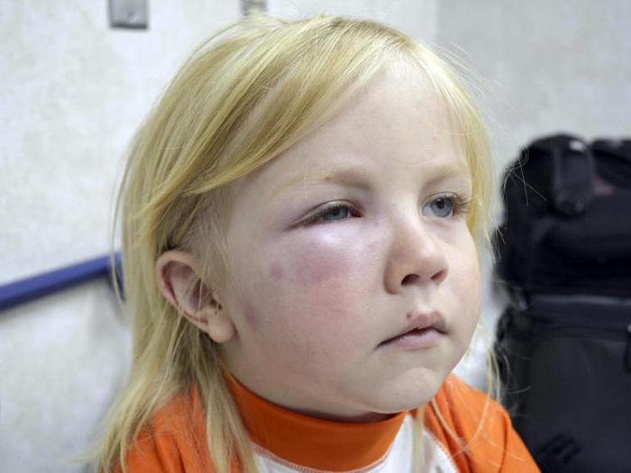 allergies in the child psychological reasons