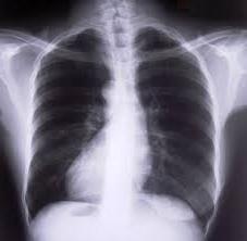 Causes and symptoms of chronic obstructive bronchitis. Its diagnosis and treatment