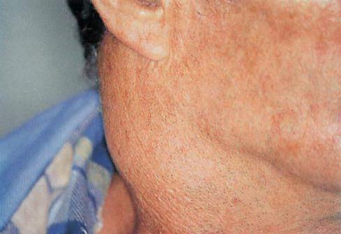 Causes and symptoms of inflammation of the lymph nodes on the neck
