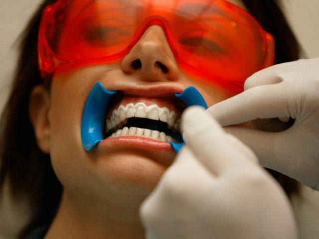 Tooth whitening procedure: reviews and recommendations